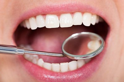 Close up of dental mirror examining dental implants