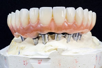 Example of implant dentures from Quiet Corner Dental