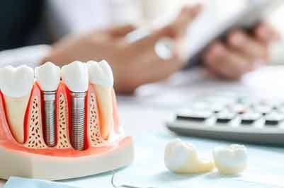 Model dental implants next to false teeth and a calculator on a desk with hands blurry in the background