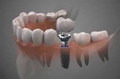 Rendering of a dental implant in a lower arch showing the titanium rod, abutment, and crown separately